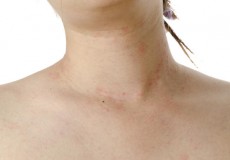 Atopijski dermatitis in vitamin D
